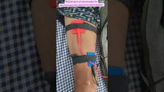 Placement of electrode for neuromuscular electrical muscle stimulation for ms reeducationshorts [upl. by Airrotal]