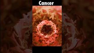 Esophageal Cancer cancer mbbs savelife [upl. by Ecnerwaled451]