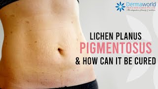 How to cure Lichen Planus Pigmentosus  Lichen Planus Pigmentosus Treatment  Dr Rohit Batra [upl. by Lauder]