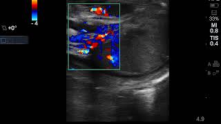 Case 1  Epididymo orchitis clip 2 [upl. by Rosalinde]