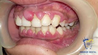 Severe gingivitis amp gingival hyperplasia [upl. by Dahle]