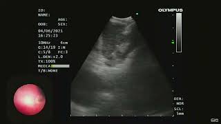 Mediastenal NUT cell carcinoma  Endobronchial Ultrasound EBUS [upl. by Lassiter757]