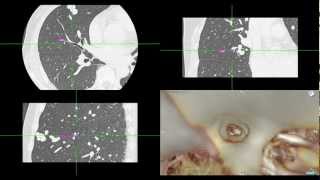 Virtual Bronchoscopy with navigation [upl. by Eicyac]