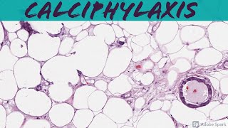 Calciphylaxis A Deadly Complication of End Stage Renal Disease ESRDChronic Kidney Disease [upl. by Anytsyrk]