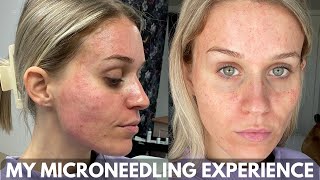 MY MICRONEEDLING EXPERIENCE amp Full Week Healing Process [upl. by Akiemat451]