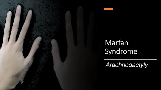 Marfan Syndrome Wrist and Thumb Sign [upl. by Annaerdna797]