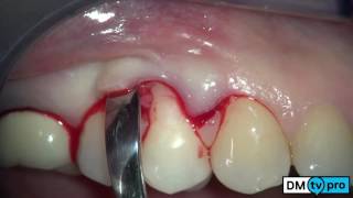 Single gingival recession treatment with Mucograft matrix [upl. by Alfreda]