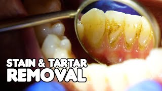 Dental Cleaning EXPLAINED  Stain amp Tartar Removal [upl. by Mikeb]