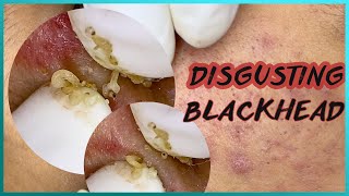 Big Cystic Acne Blackheads Extraction Blackheads amp Milia Whiteheads Removal Pimple Popping [upl. by Yaya]