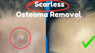 Scarless Osteoma Removal Bony swelling removal from forehead Best osteoma Removal [upl. by Garibald]