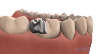 Inlays and onlays  Lapointe dental centres [upl. by Naerad]