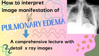 Pulmonary edema Xrays manifestation II How Edema fluid can be diagnosed on chest Xrays [upl. by Debbee935]