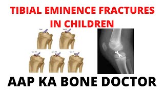 TIBIAL EMINENCE FRACTURES IN CHILDREN  EPISODE 56 [upl. by Buxton]