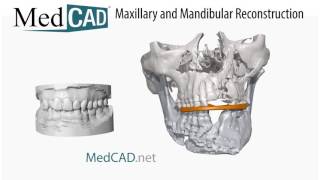 Maxillary and Mandibular Reconstruction with Occlusal Splints [upl. by Judsen111]