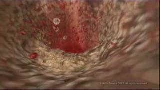 MEDICAL  How cholesterol clogs your arteries atherosclerosis [upl. by Belsky]