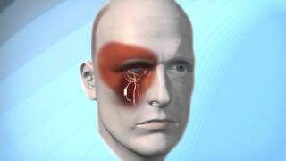 Pulsante Microstimulator for Cluster Headache [upl. by Ecnarepmet]