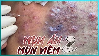 Big Cystic Acne Blackheads Extraction Blackheads amp Milia Whiteheads Removal Pimple Popping [upl. by Ssilem]