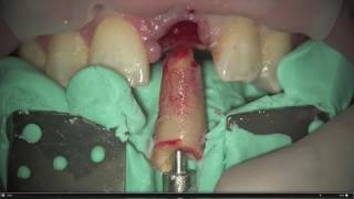 Dental Excellence 17 Root Extraction System [upl. by Aihtak]