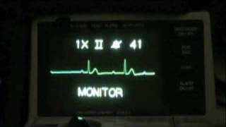 Vital Ethics ACLS ECG Recognition Sacramento [upl. by Margeaux]