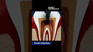 Tooth infection  Abscess  Caries  Symptoms  Treatments  Dentalexperiencein [upl. by Nylirak]