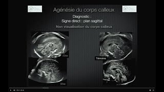 MALFORMATIONS CEREBRALES EN ECHOGRAPHIE OBSTETRICALE [upl. by Dachia]