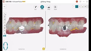 06 DEXIS IS ScanFlow 스캔 방법임플란트 스캔 [upl. by Jeritah]