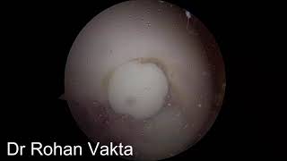 OATS mosaicplasty for Osteochondral defect cartilage repair [upl. by Anait999]