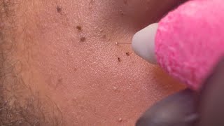 Skin Tag amp DPN Dermatosis Papulosa Nigra Removal [upl. by Weisler802]