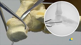 Calcaneal Tuberosity  Malalignment  Correction Osteotomy with Stabilization [upl. by Enyale]