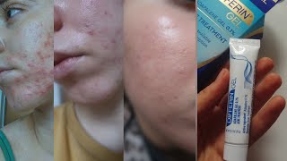 Differin Gel  How I got rid of my active breakouts 547 days of using it [upl. by Nagard]