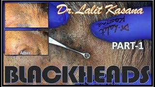 BLACKHEADS PART1 BY DRLALIT KASANA [upl. by Niuqram]