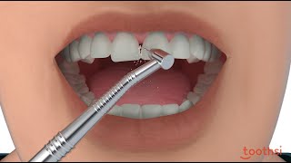 Toothsi IPR  Teeth Gap Treatment [upl. by Aimahc]