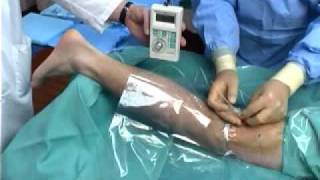 Continuous Popliteal Nerve Block [upl. by Ivek]