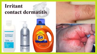 irritant contact dermatitis [upl. by Lhok565]