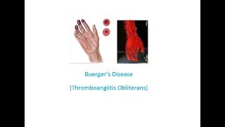 Buergers Disease Thromboangiitis Obliterans Easy Health Exploring [upl. by Euqinwahs]