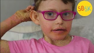 Living With Scaly Skin Ichthyosis [upl. by Lauer279]