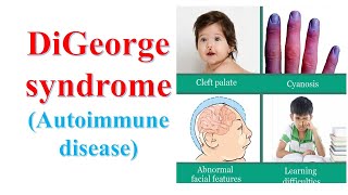 Digeorge syndrome Autoimmune disease [upl. by Lucho831]