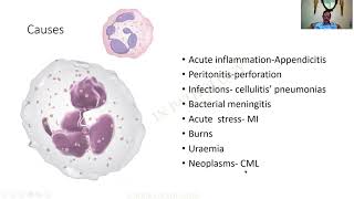 Neutrophilia  GAME 44  Pathology practical slides  MBBS  SRM  Dr GSS  University questions [upl. by Myriam296]