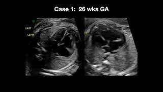 2023 Fetal Echocardiography Normal and Abnormal Hearts  A Video CME Teaching Activity [upl. by Ettevi381]