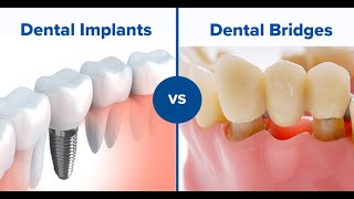 Which is better a dental bridge or implant [upl. by Razid]