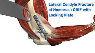 humerus lateral condyle fracture  reduction and fixation with plate [upl. by Tamqrah390]