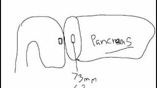 Whipple Procedure Pancreatic Anastomotic Techniques Part  1 [upl. by Zulch]