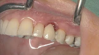 NobelActive clinical case immediate implant placement  Eric Rompen [upl. by Ellertnom]