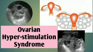 Case report Ovarian Hyperstimulation Syndrome OHSS🤰🤰USG imagingRadiology 20 [upl. by Asatan]