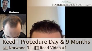 Norwood 3 Hair Transplant Surgery Day amp 9Month Followup Dr Matt Huebner Reed [upl. by Trueman]