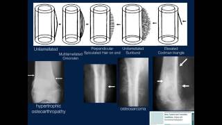 Bone Lesions Radiographic Assessment Part 1 by Geoffrey Riley MD [upl. by Penrod]