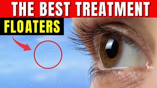 How to Get Rid of Eye Floaters  Eye Floaters Best Natural Treatment [upl. by Rodman348]