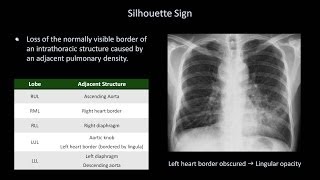 How to Interpret a Chest XRay Lesson 8  Focal Lung Processes [upl. by Katy]