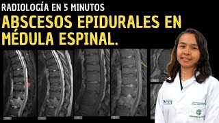 Radiología en 5 minutos Abscesos epidurales en médula espinal [upl. by Leirol63]