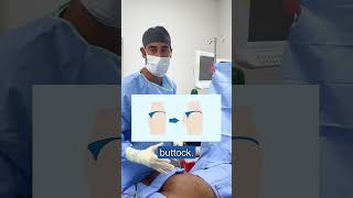 Steps of a Brazilian Butt Lift BBL with Dr Zuri in Miami  Zuri Plastic Surgery [upl. by Siblee]